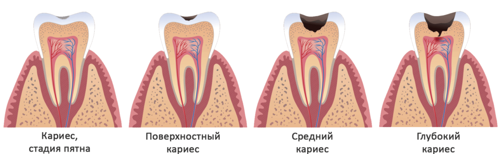 Поверхностный и средний кариес. Кариес зубов Поверхностный и средний кариес. Кариес зубов