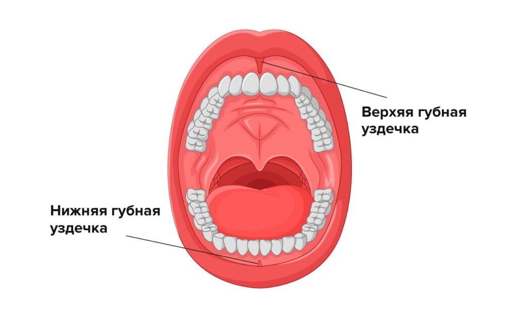Иллюстрация губной уздечки Губная уздечка на примере иллюстрации ротовой полости
