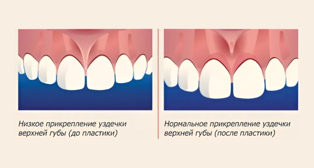 Патологии, при которых нужна пластика уздечки Иллюстрация показывающая низкое крепление уздечки и нормальное
