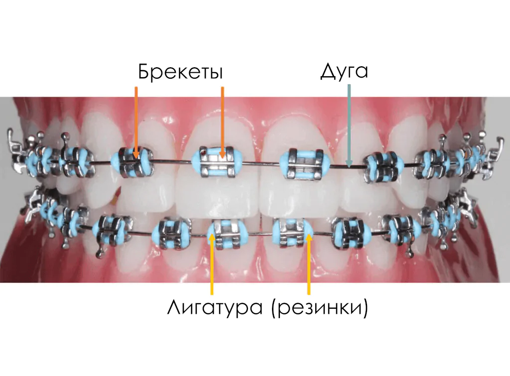 Установка брекетов. Компоненты брекет-системы. Брекеты Установка брекетов. Компоненты брекет-системы. Брекеты