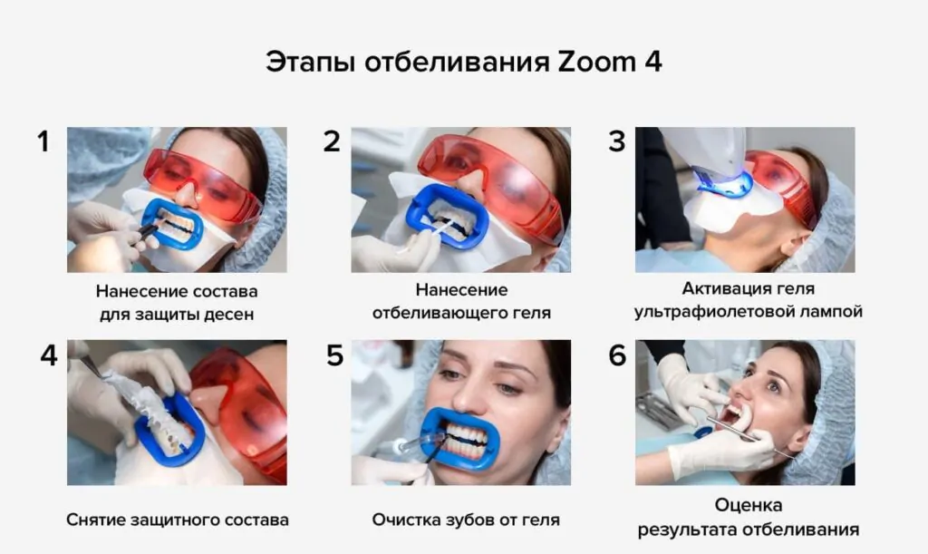 Этапы отбеливания ZOOM 4. Девушка на процедуре отбеливания зубов Этапы отбеливания ZOOM 4