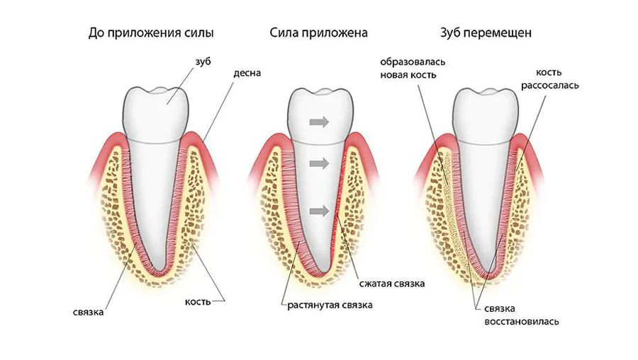 Иллюстрация демонстрирующая принцип работы металлических брекетов Иллюстрация демонстрирующая принцип работы металлических брекетов