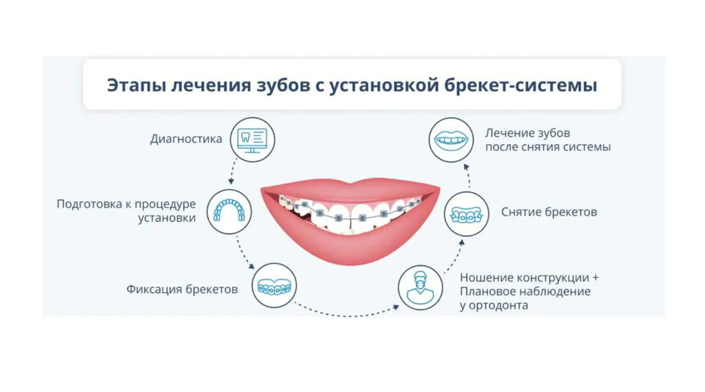 Этапы исправления прикуса брекетами, наглядная иллюстрация Этапы исправления прикуса брекетами, наглядная иллюстрация на белом фоне