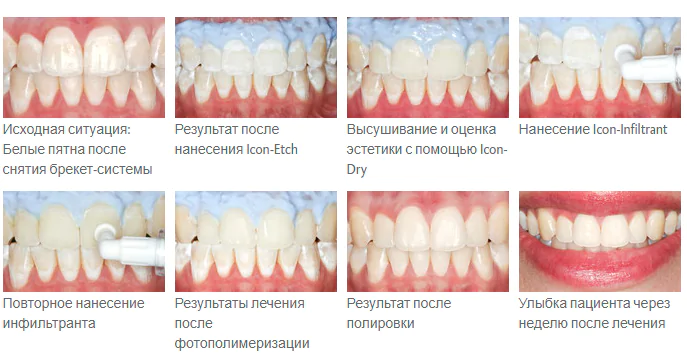 процесс лечения кариеса пошагово процесс лечения кариеса пошагово