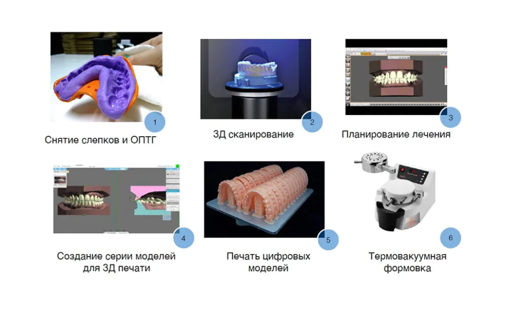 Этапы изготовления элайнеров Поэтапное изготовление элайнеров