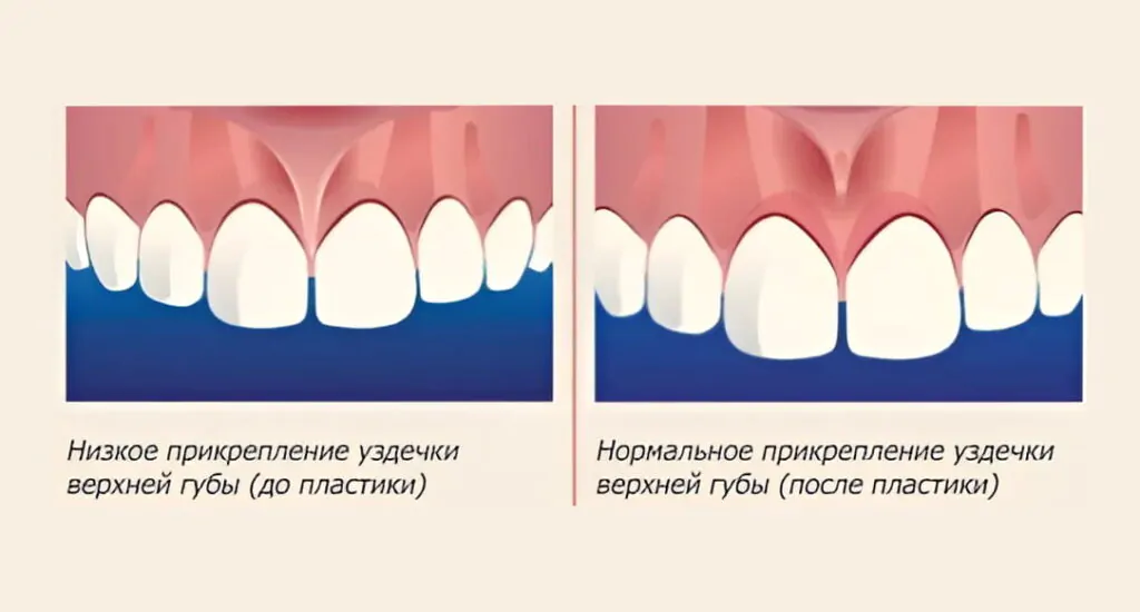 Патологии, при которых нужна пластика уздечки Иллюстрация показывающая низкое крепление уздечки и нормальное