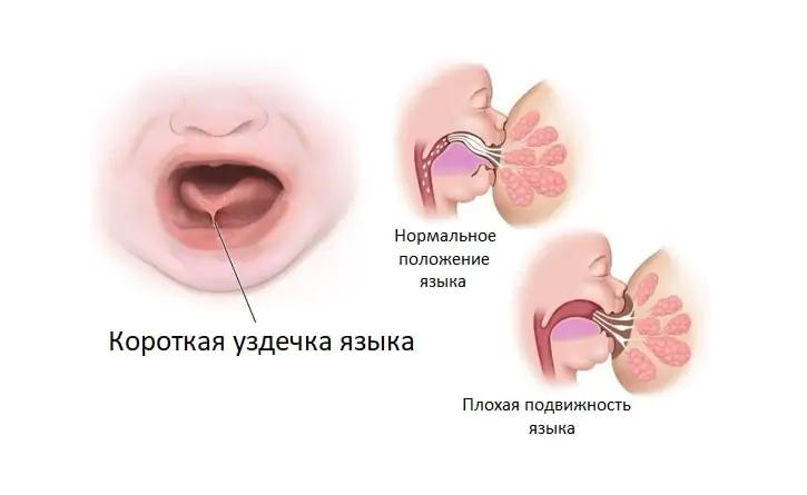 Патологии уздечки языка у новорожденного на примере иллюстрации Иллюстрация показывающая уздечку языка у новорожденного