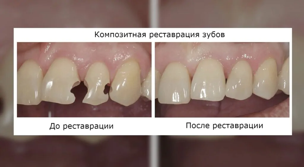Зубы до и после композитной реставрации Зубы до и после композитной реставрации