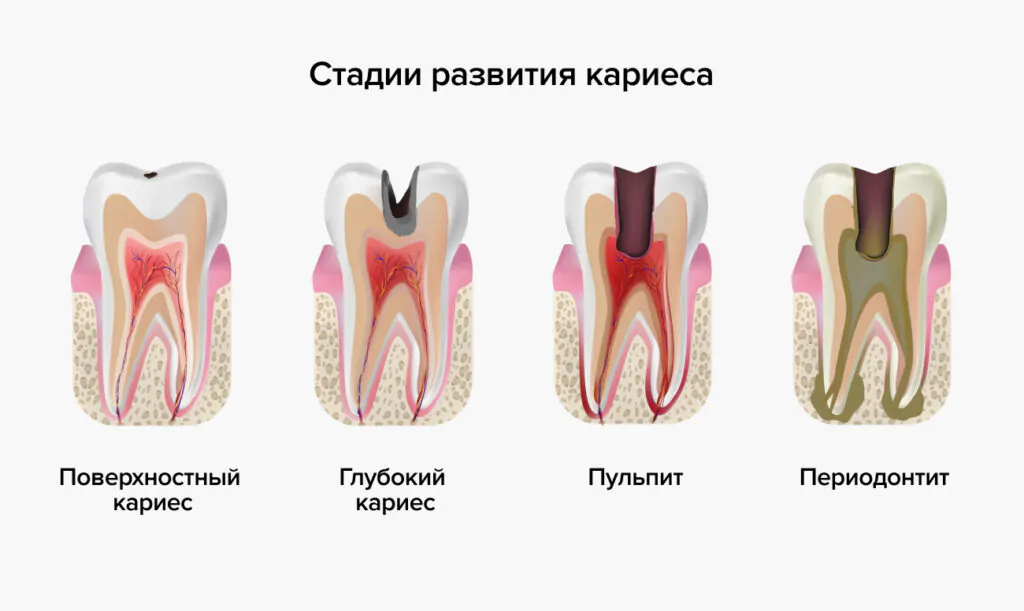 Процесс развития кариеса Процесс развития кариеса