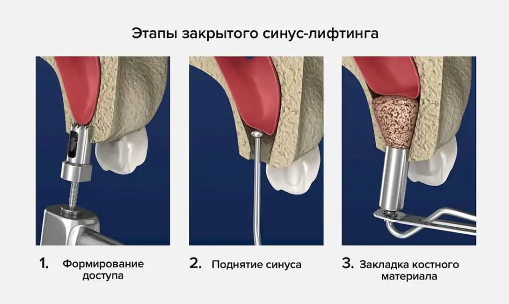 Этапы процедуры закрытого синус-лифтинга