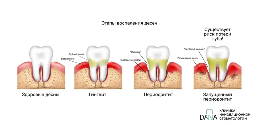 Этапы воспаления десен Иллюстрация показывающая этапы воспаления десен