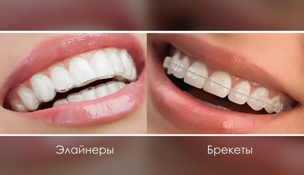 Отличие элайнеров от брекетов Сравнение элайнеров и брекетов